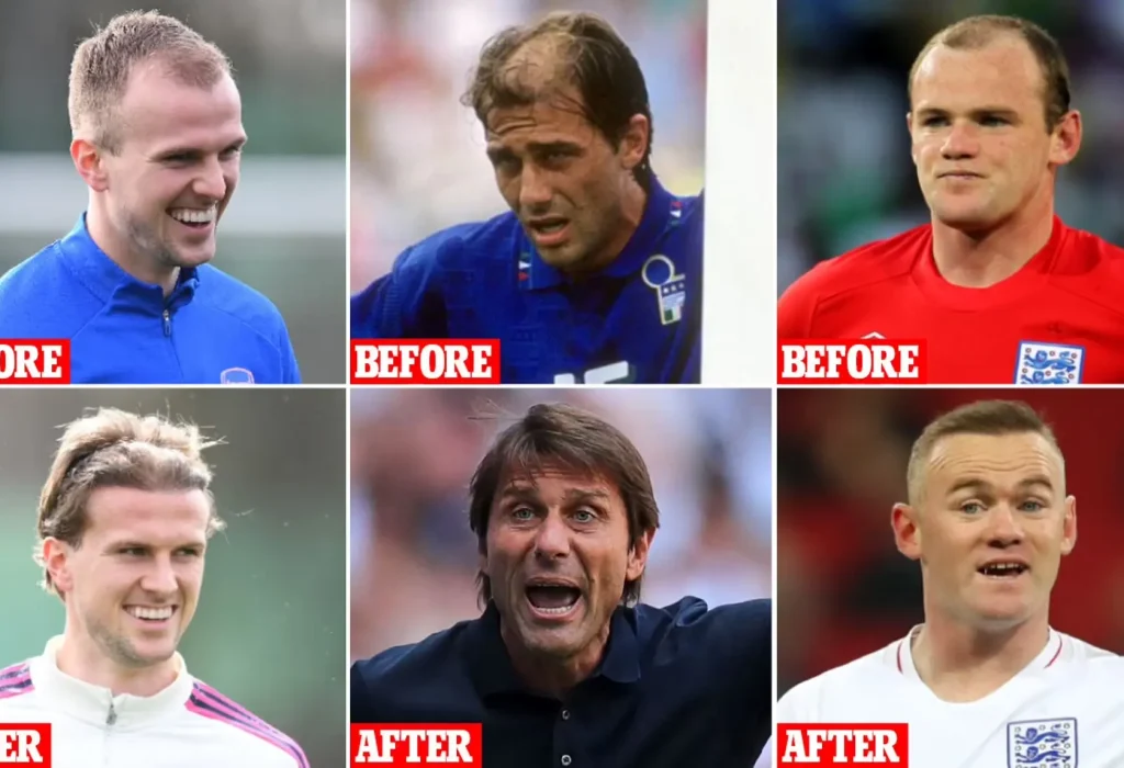 footballers.with-hair-transplant