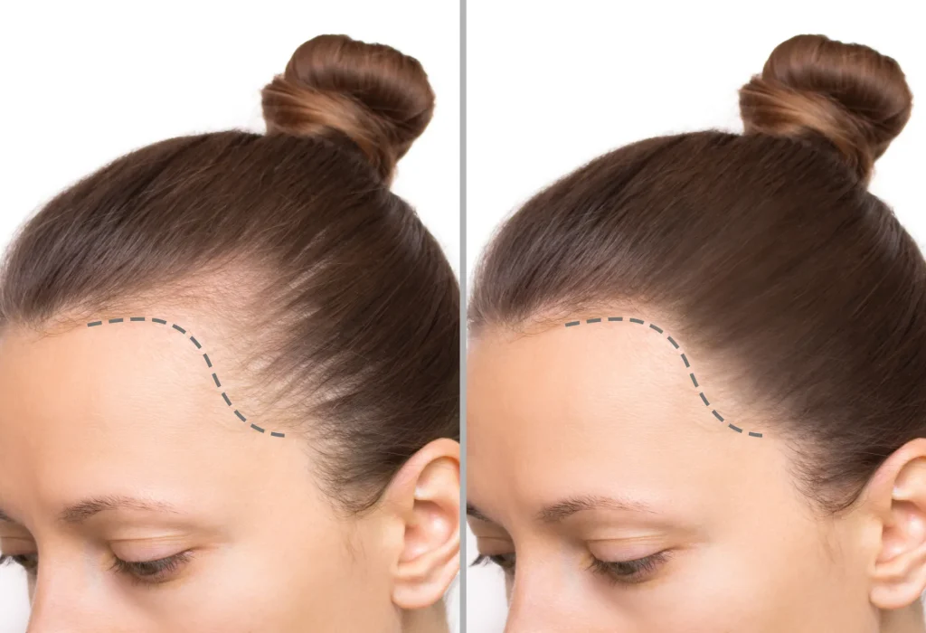 frontal-female-hair-transplant