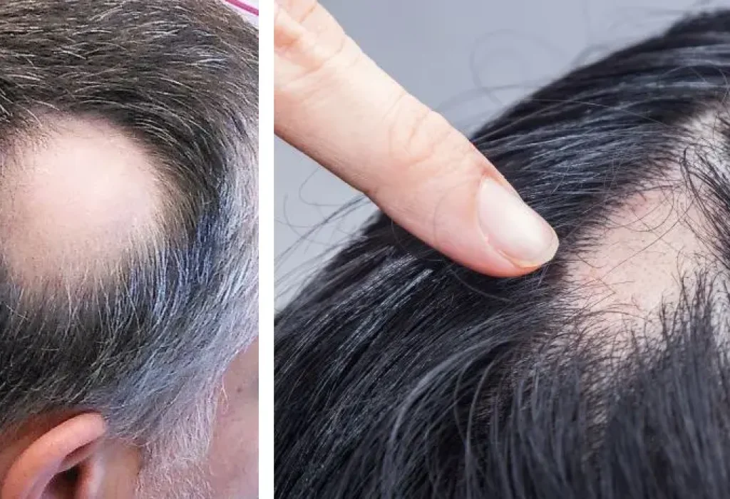 hair-loss-from-stress