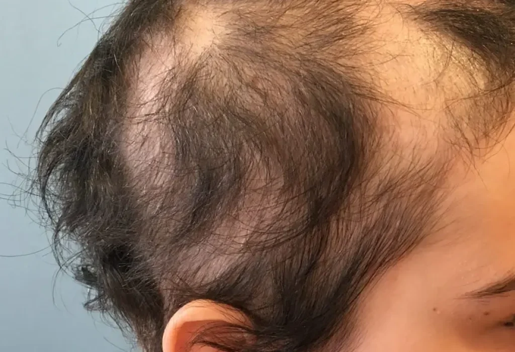 hair-loss-in-adolescence