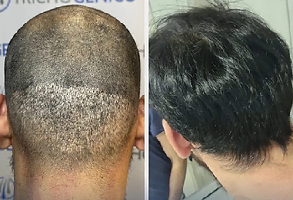 hair-scar