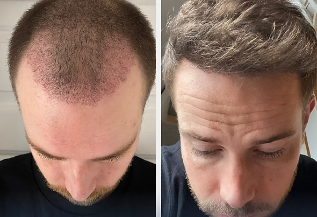 hair-trans-cost