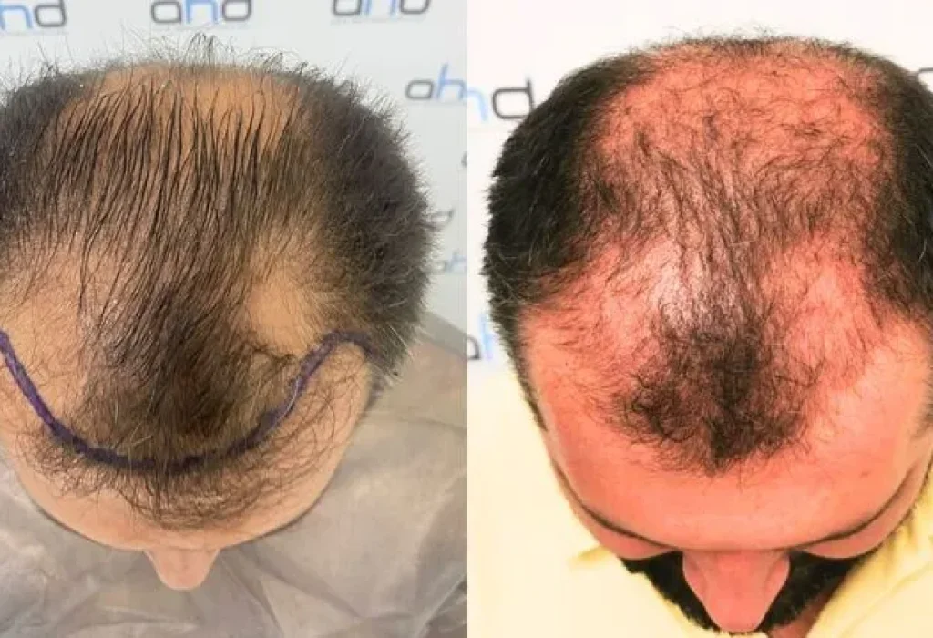 hair-transplant-bald-patch