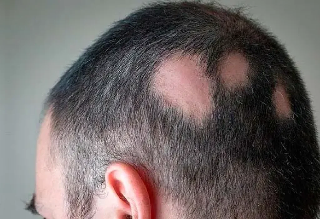 hair-transplant-bald-patch