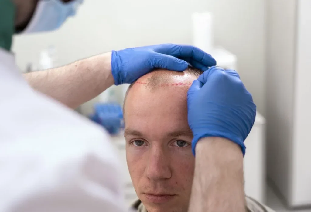 hair-transplant-expenses