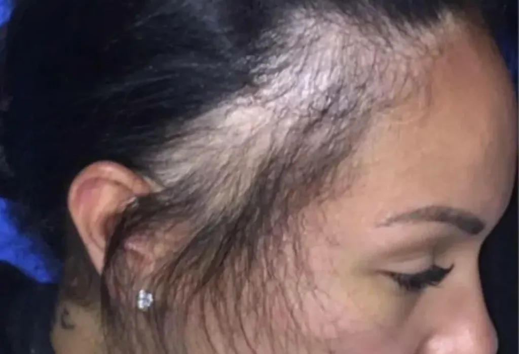 hair-transplant-for-traction-alopecia-1