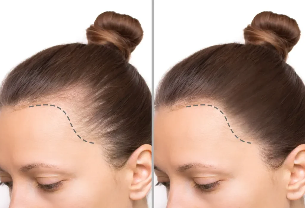 hair-transplant-for-women-1