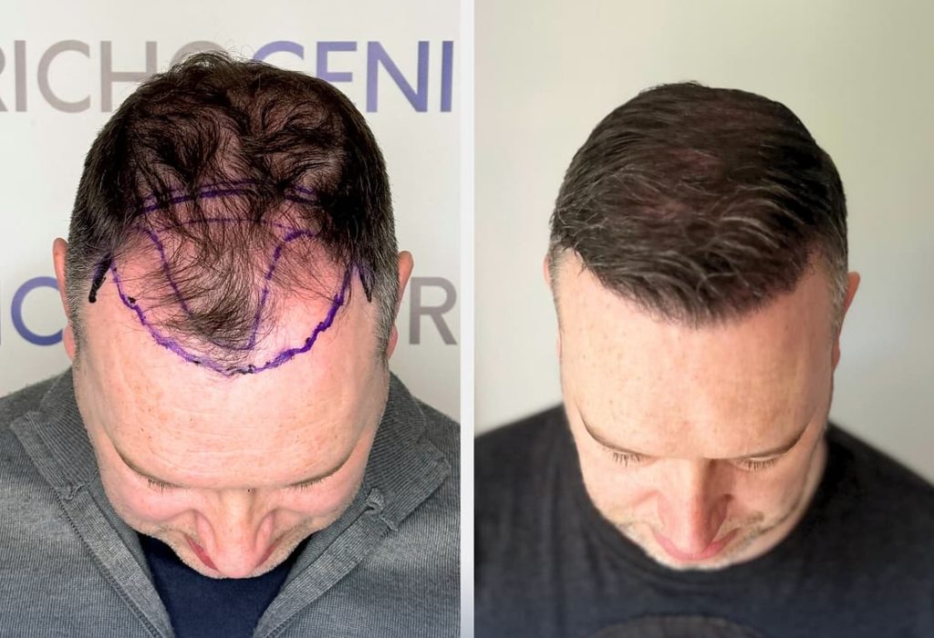 hair-transplant-from-another-person