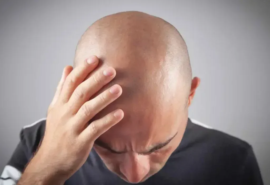hair-transplant-full-baldness-1