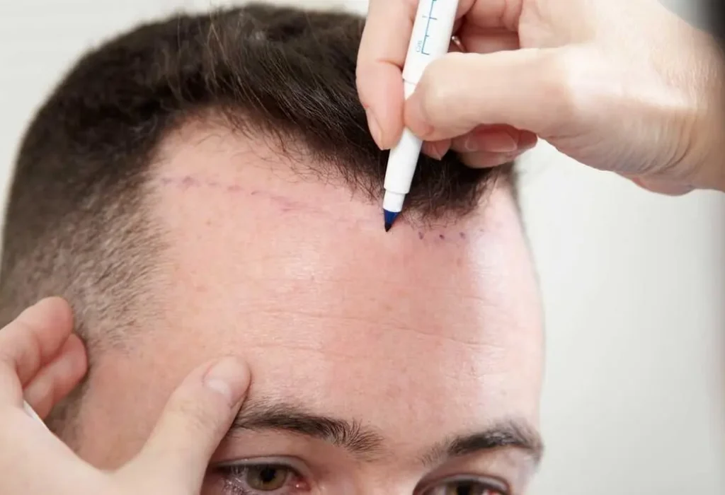 hair-transplant-methods