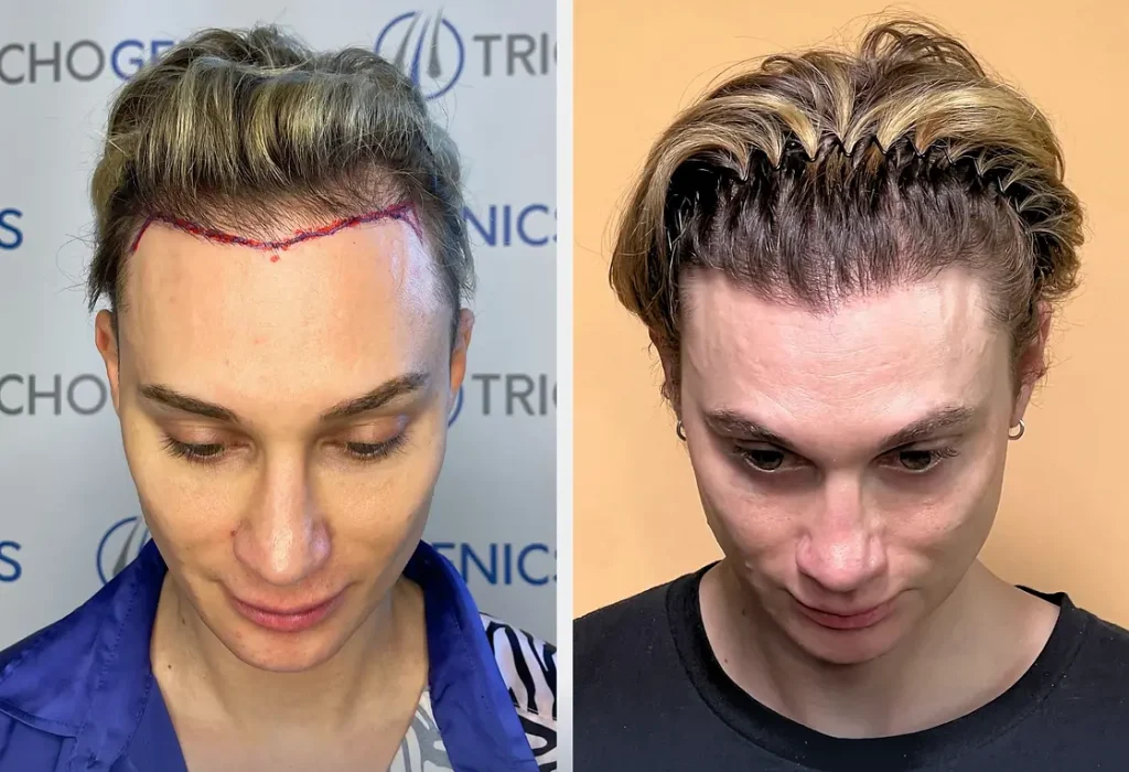 hair-transplant-of-forehead-reduction