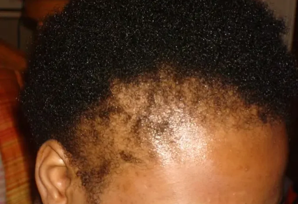 hair-transplant-on-black-female