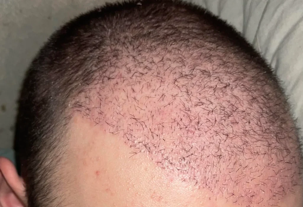 hair-transplant-shedding-phase-1