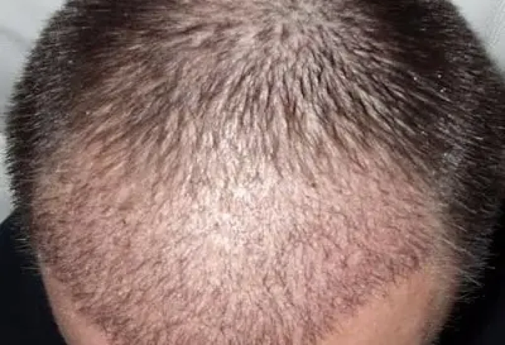 hair-transplant-shedding-phase