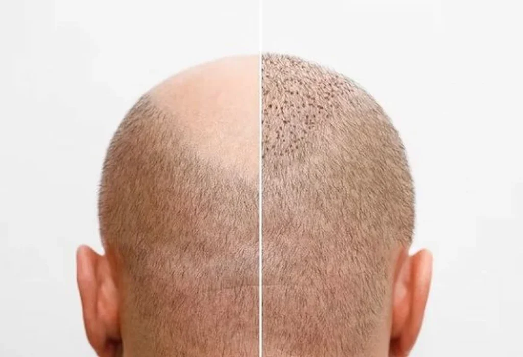 hair-transplant-techniques
