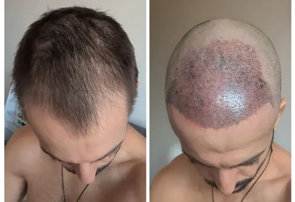 hair-transplant-ugly-ducklint-phase