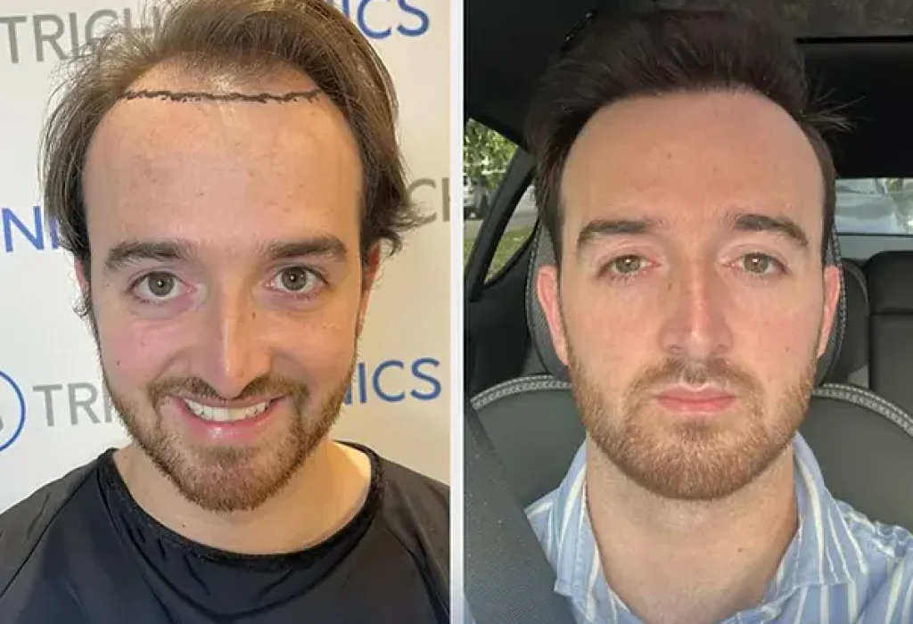 hair-transplant-with-long-hair-1