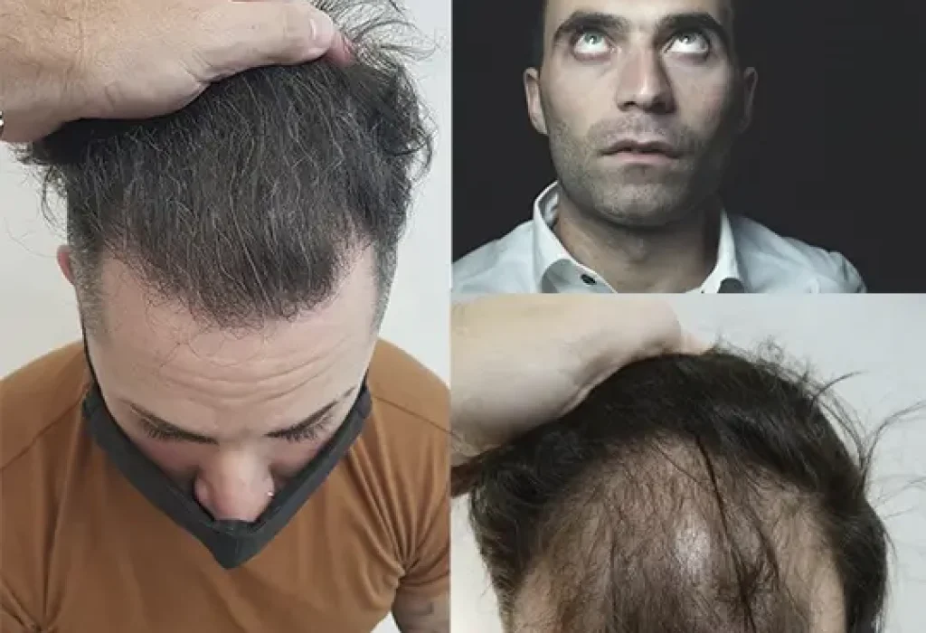 how-long-does-transplant-hair-last-2