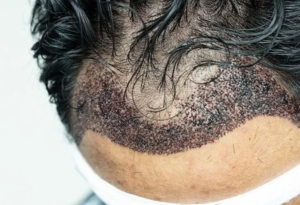 infection-hair-transplant