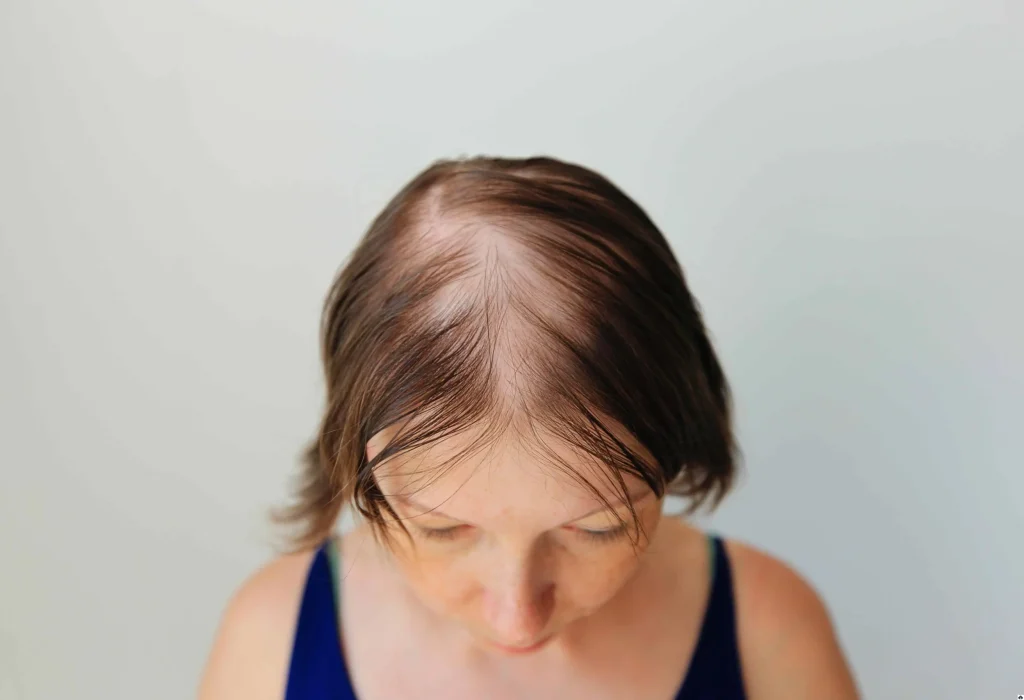 is-diffuse-hair-thinning-reversible