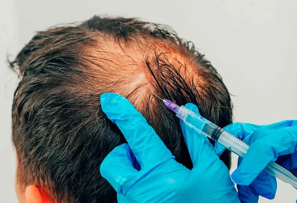 mesotherapy-for-hair-1