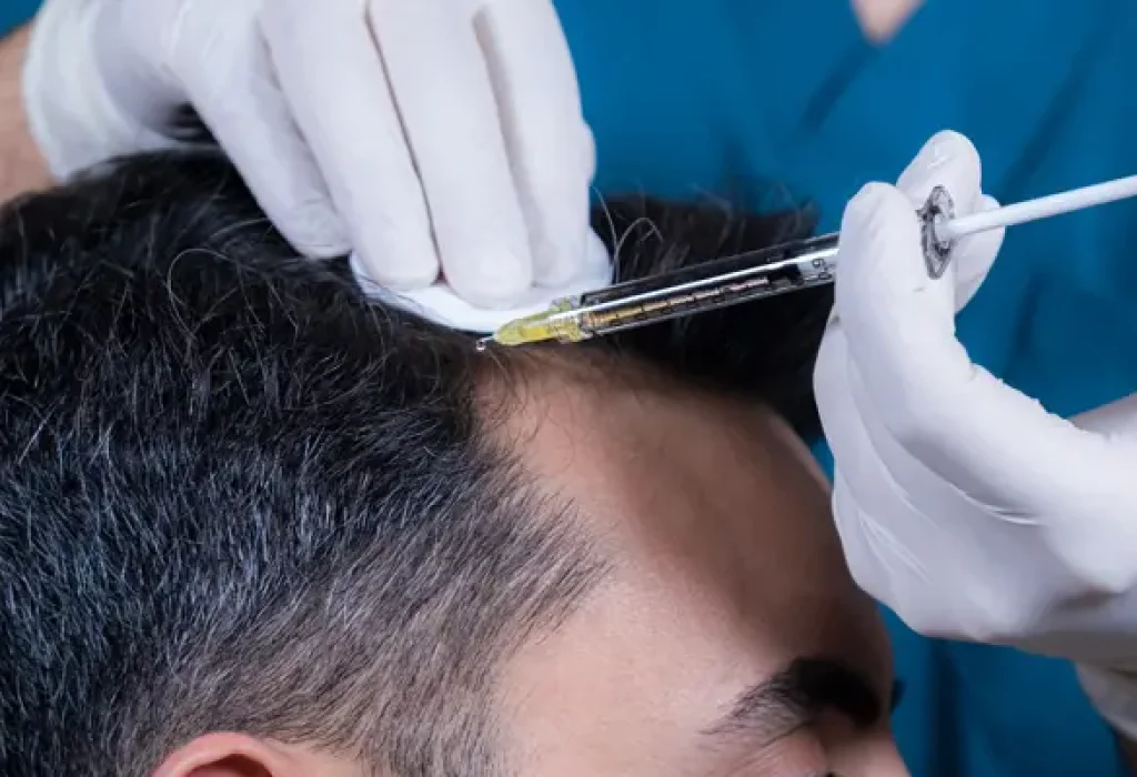 mesotherapy-for-hair