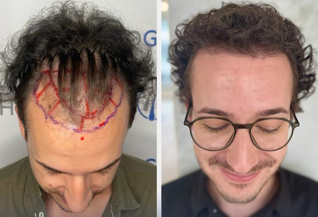 most-expensive-hair-transplant