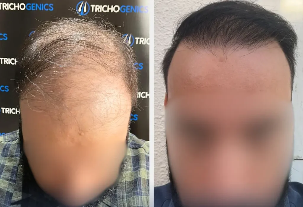 norwood-5-hair-transplant