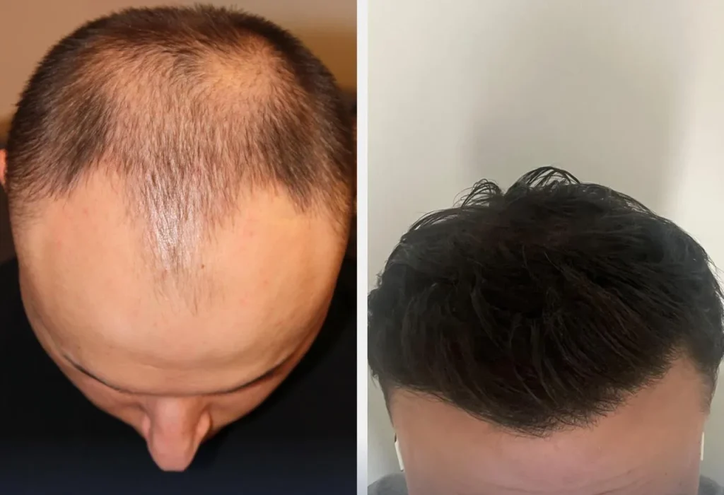norwood-7-hair-transplant