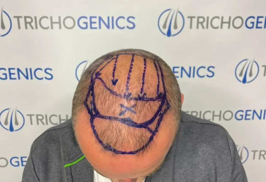 norwood-7-hair-transplant6