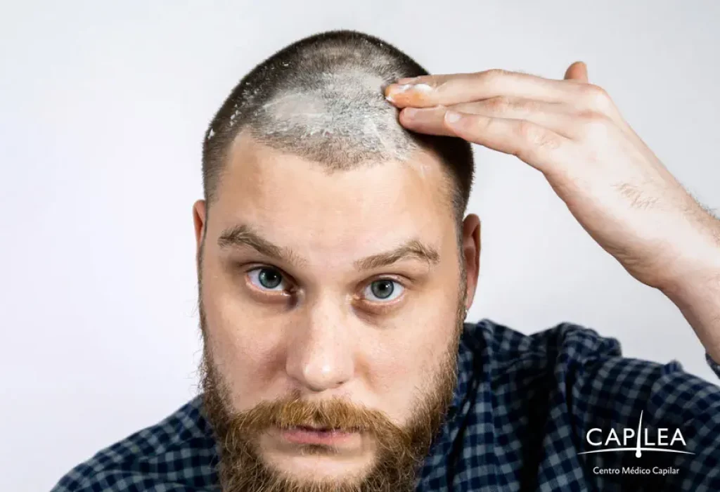 scab-after-hair-transplant-1