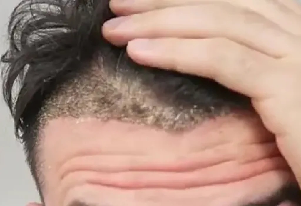 scab-after-hair-transplant