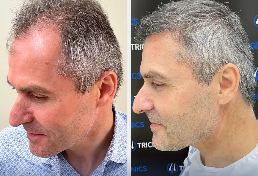 second-hair-transplant