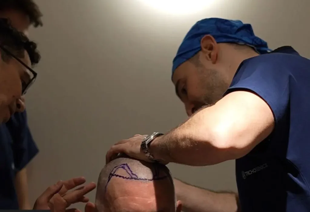 shave-my-head-for-a-hair-transplant