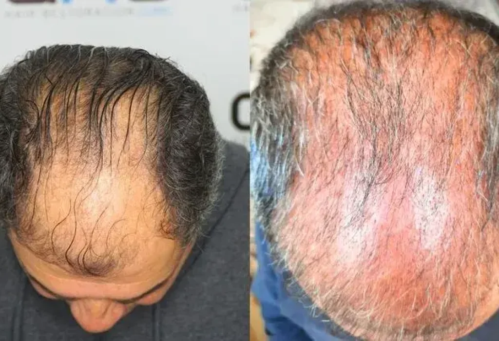 shock-loss-hair-transplant