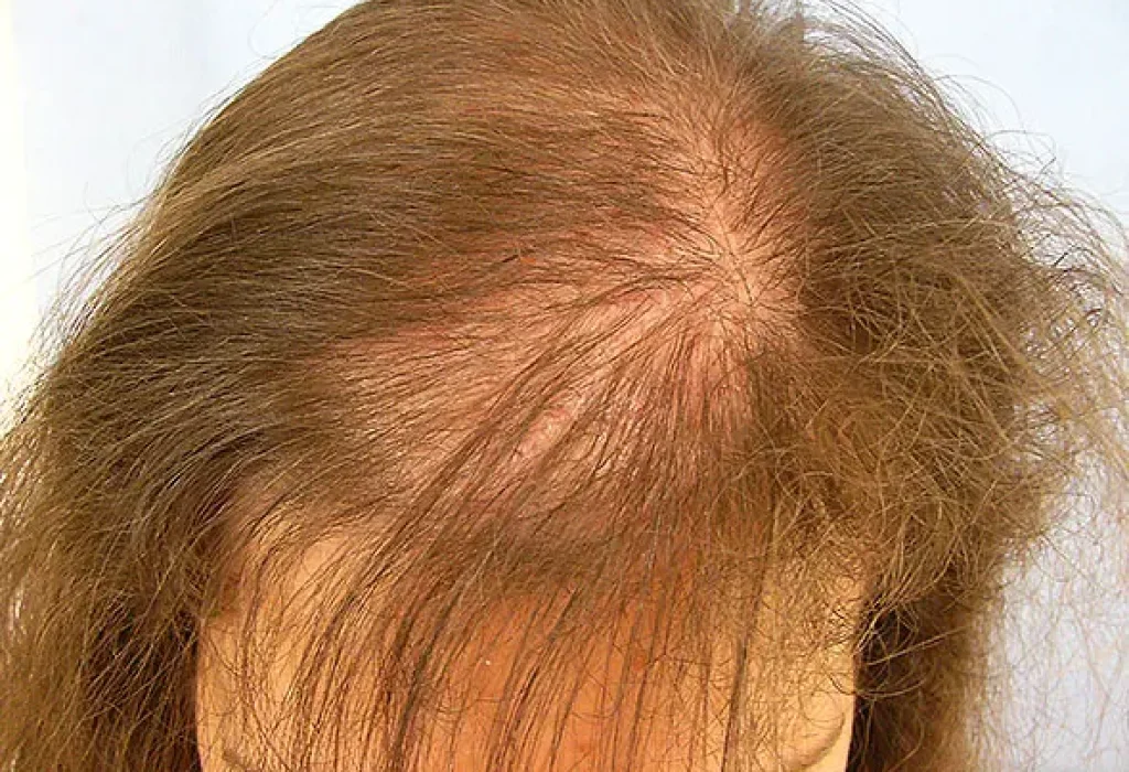thyroid-hair-loss