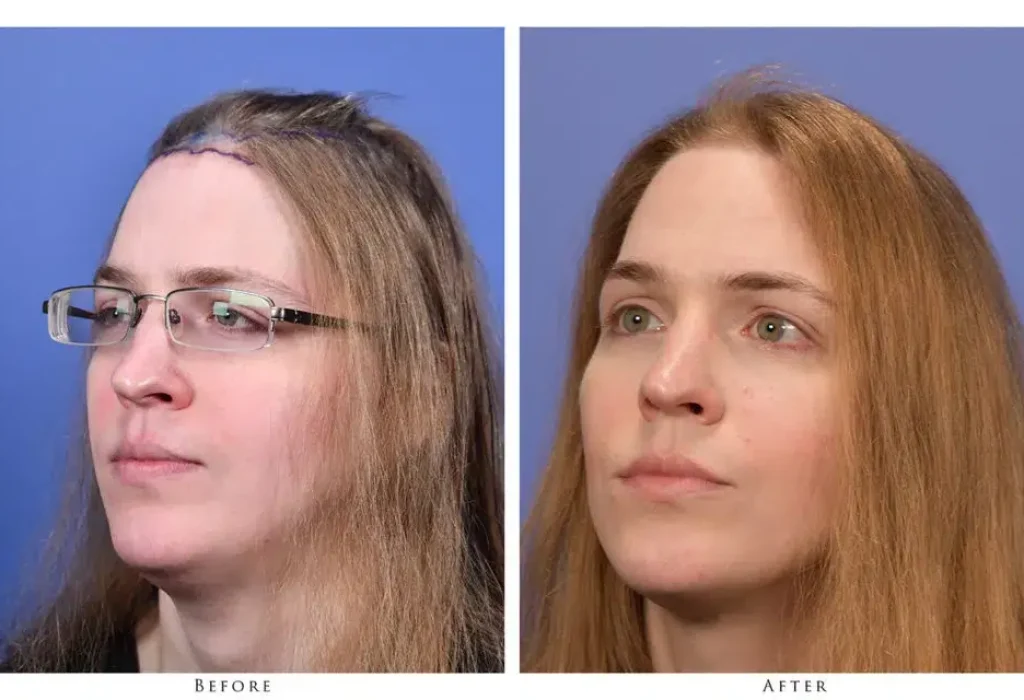 transgender-hair-transplant-1