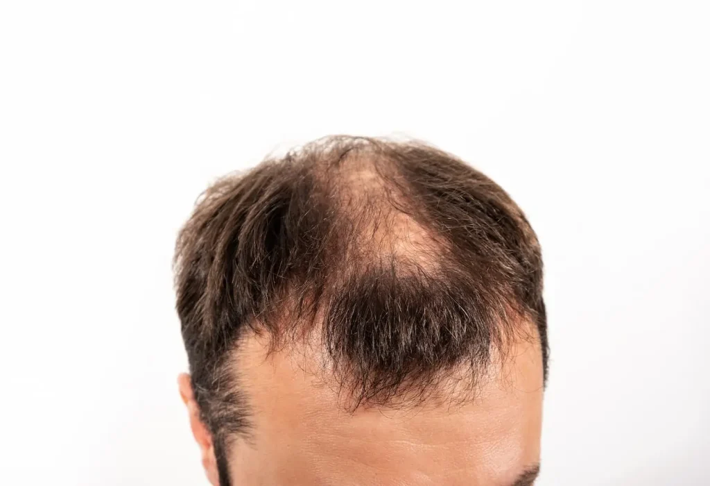 transplanted-hair-falling.out-after-2-years-1