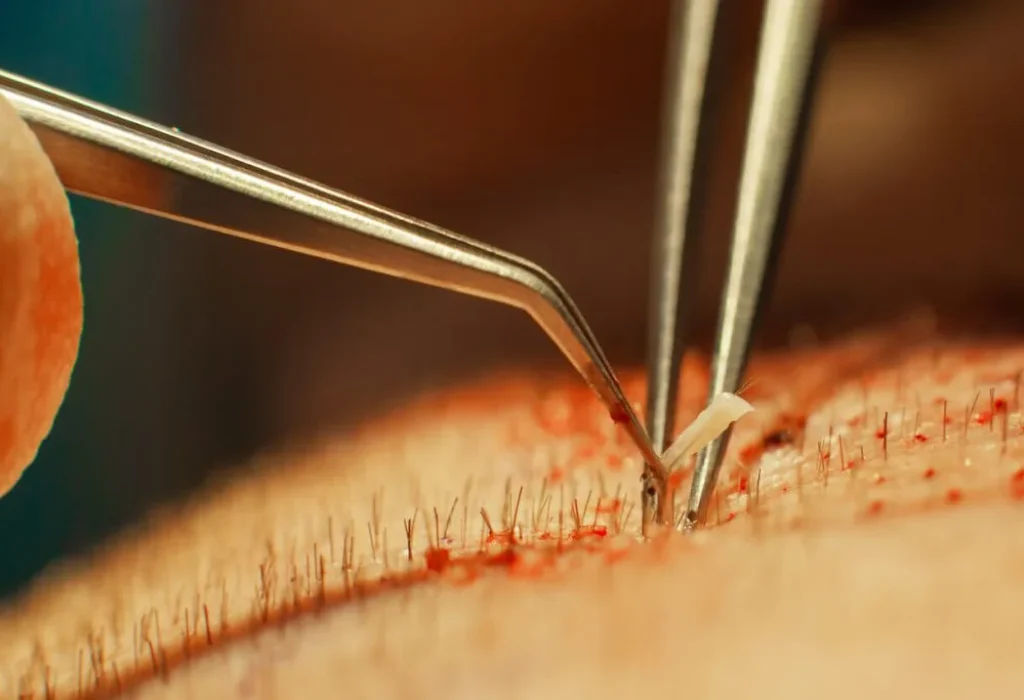 where-does-the-hair-come-from-for-hair-transplants