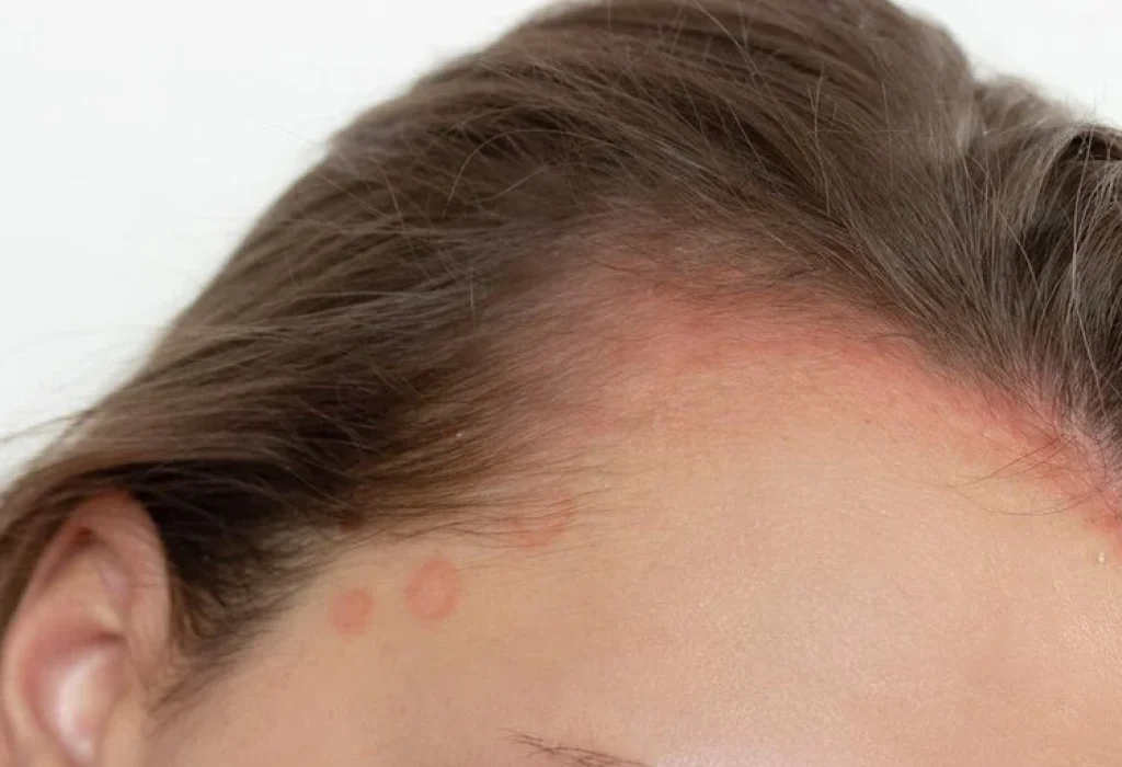 will-seborrheic-dermatitis-cause-hair-loss
