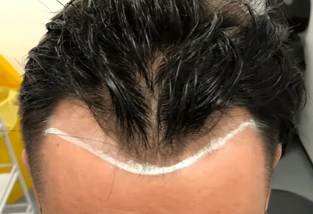 window-peak-hair-transplant