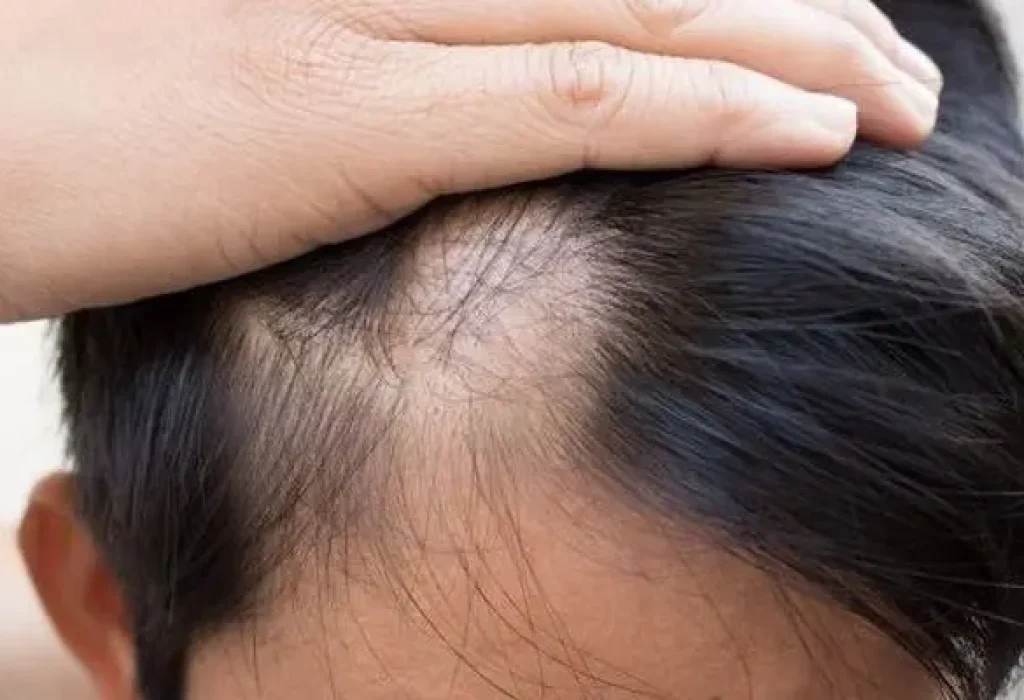 zinc-hair-loss
